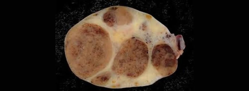 Teka Lutein Kistleri